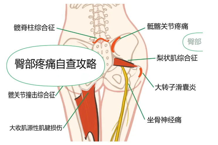 髋关节疼痛自查指南：可能暗示哪些疾病？